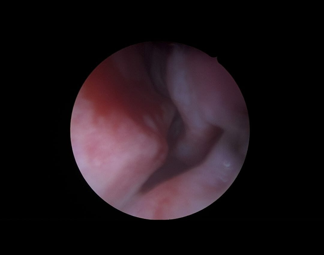 تقويم الحاجز الأنفي