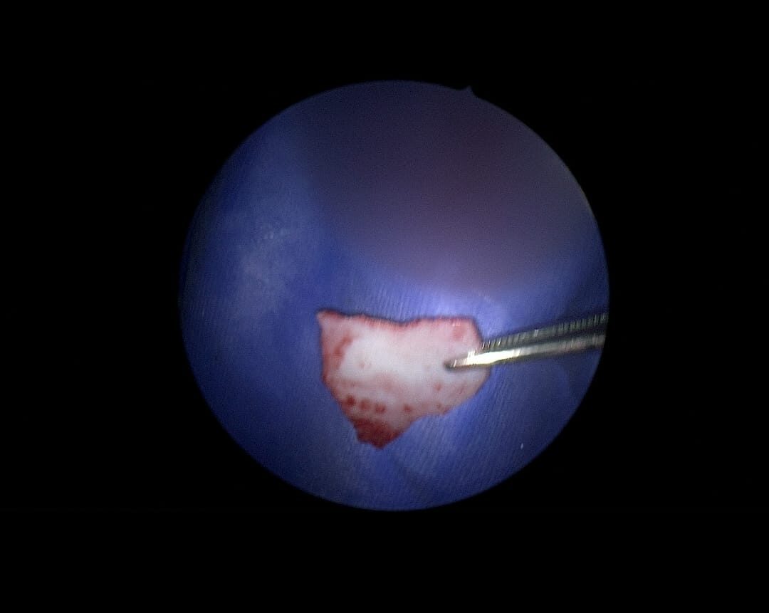 عملية الأنف