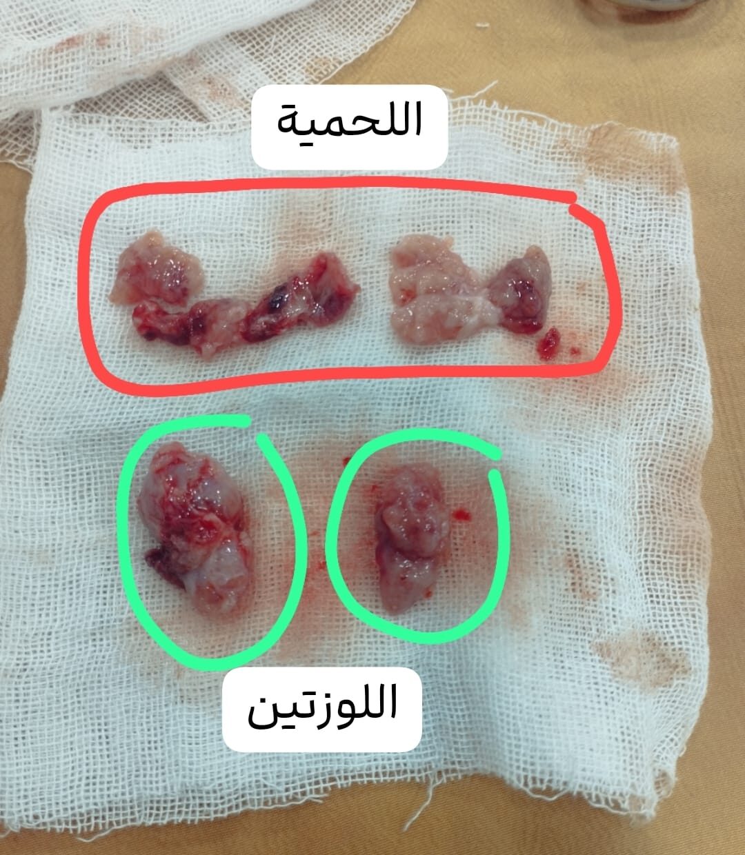 جراحة الحنجرة